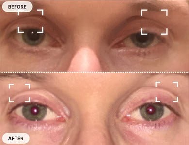 Eyelid Ptosis Before and After Pictures