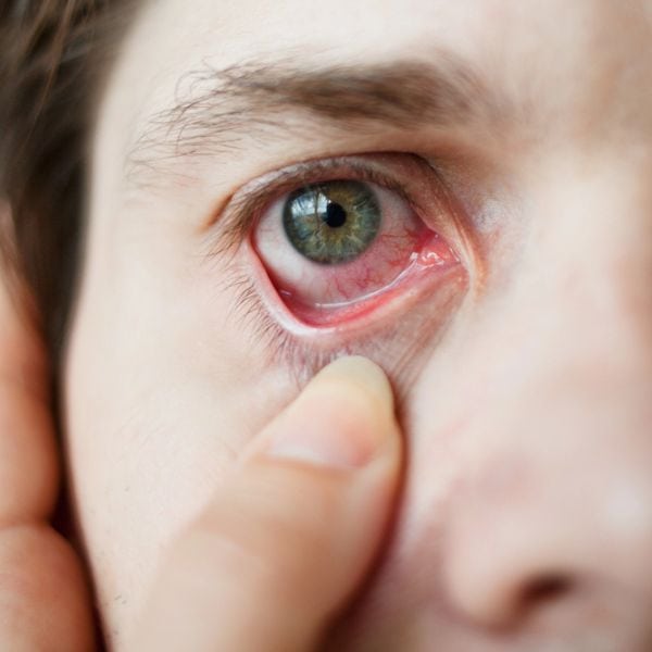 Irritated Eye