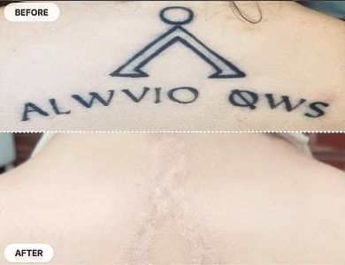 Non Laser Tattoo Removal Before and After Pictures