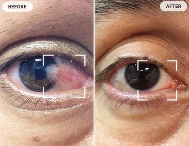 Pterygium Before and After Pictures