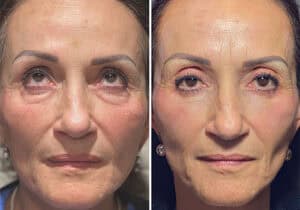 Woman's lower eyelids improved after surgery at Assil Gaur Eye Institute.