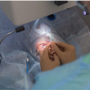 Close-up of a surgeon performing LASIK eye surgery in a clinical setting.
