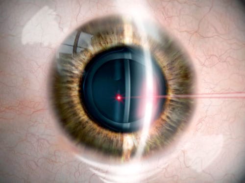YAG laser posterior capsulotomy eye illustration