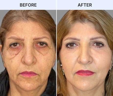 Patient with hollowed circles under eyes after weight lostt