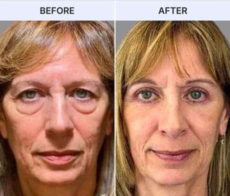 Before & After of Patient following Quadruple Blepharoplasty
