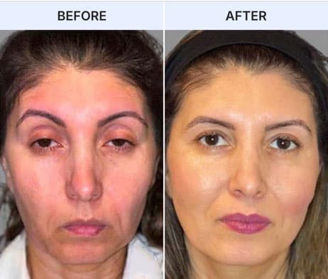 Before & after of patient with Brow Ptosis and Upper Lid Blepharoplasty