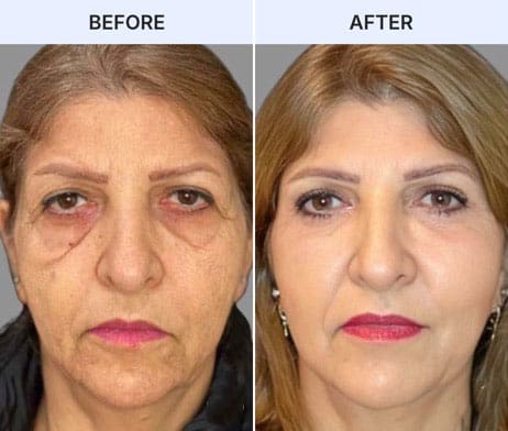 Before and after eye rejuvenation treatment for Ozempic Face.