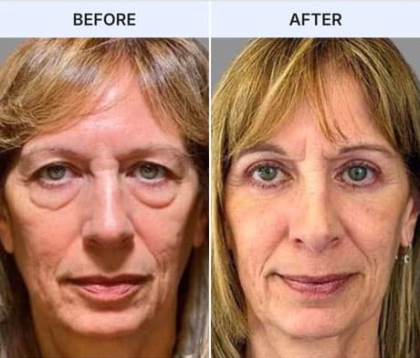 Before and after eye rejuvenation treatment for Ozempic Face.