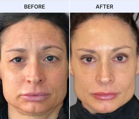 Before and after facial transformation showing improved appearance after treatment.