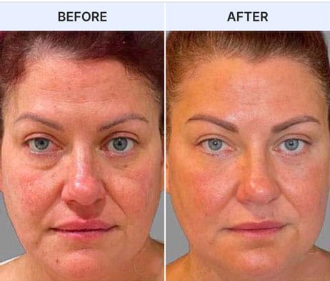 Before and after facial transformation showing skin improvement and contouring.