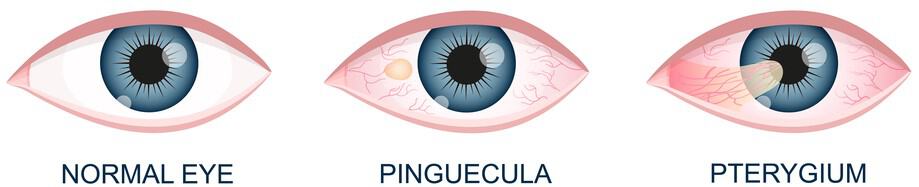 Pinguecula and pterygium diagram