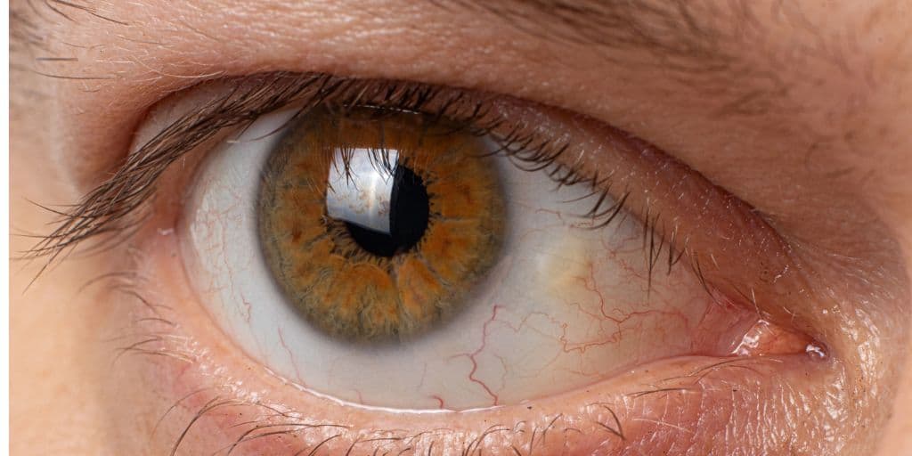 Understanding Pinguecula Causes, Symptoms, and Treatment