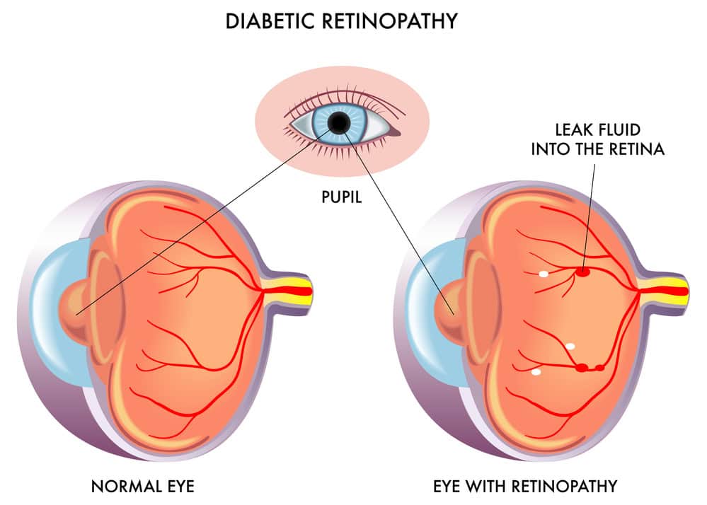 diabetic retinopathy diagram