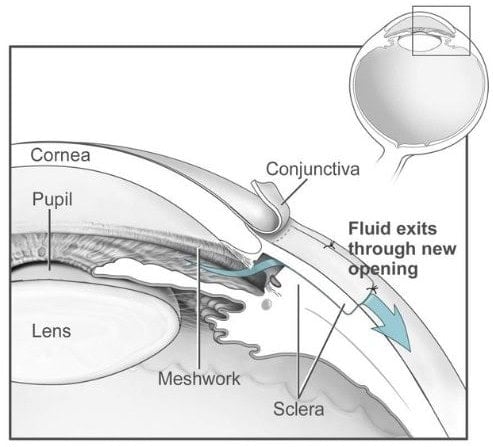 Trabeculectomy, a form of surgery to treat glaucoma.