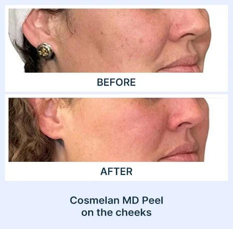 Cosmelan MD Peel before and after picture from Assil Gaur Aesthetics Los Angeles