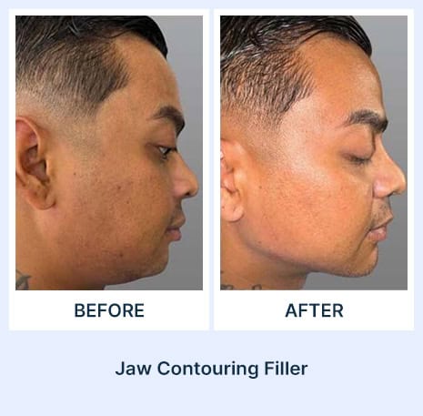 Jaw Contouring with Filler before and after picture from Assil Gaur Aesthetics Los Angeles