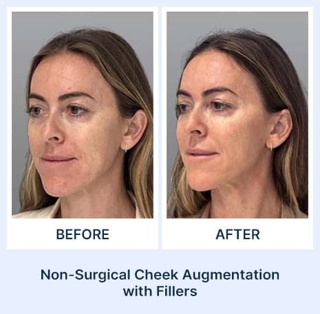 Non-surgical Cheek Augmentation before and after picture from Assil Gaur Aesthetics Los Angeles