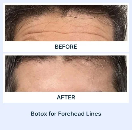 Botox for forehead lines before and after picture from Assil Gaur Aesthetics Los Angeles