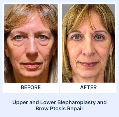 Blepharoplasty surgery before and after picture from Assil Gaur Aesthetics Los Angeles