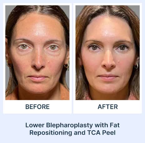 Lower Blepharoplasty Before and After Assil Gaur Aesthetics Los Angeles