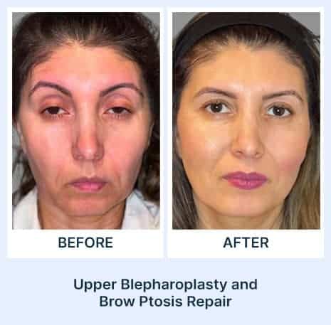 Before and after eye surgery for brow ptosis and eyelid correction.