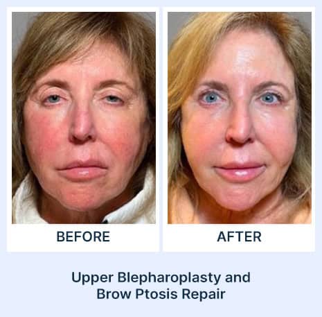 Upper Blepharoplasty before and after picture from Assil Gaur Aesthetics Los Angeles