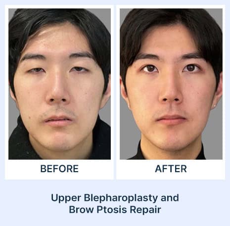 Before and after eye surgery photos showing improved eyelid and brow appearance from Assil Gaur Aesthetics Los Angeles