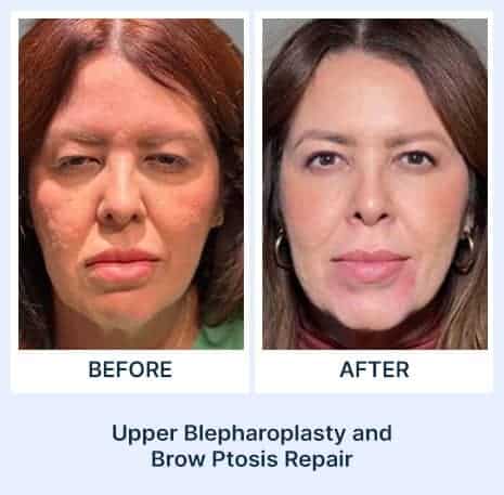 Patient's face before and after upper blepharoplasty and brow ptosis repair.