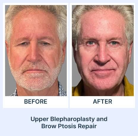 Before and after eye surgery results at Assil Gaur Eye Institute.