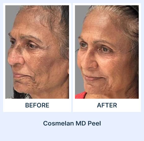 Cosmelan MD Peel Before and After Results at Assil Gaur Aesthetics Los Angeles