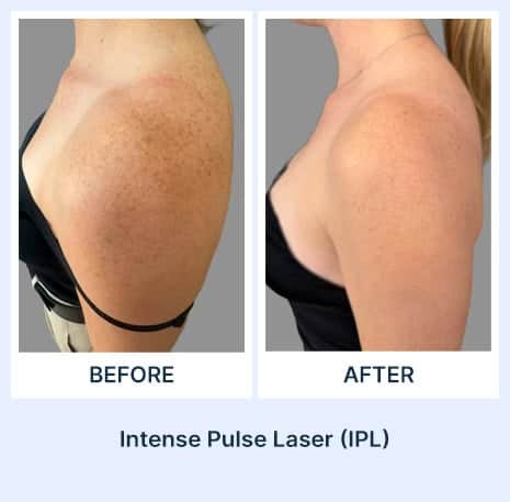 Before and after laser treatment for skin pigmentation at Assil Gaur Eye Institute.