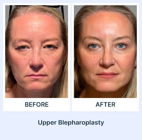 Upper Blepharoplasty before and after picture from Assil Gaur Aesthetics Los Angeles