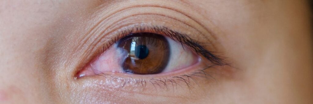 Close-up of a human eye with pterygium (surfer’s eye) condition.