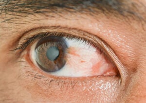 pterygium surger