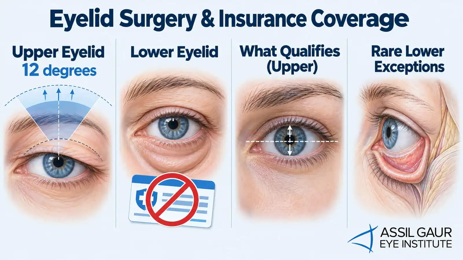 Illustration of eyelid surgery types and insurance coverage details.