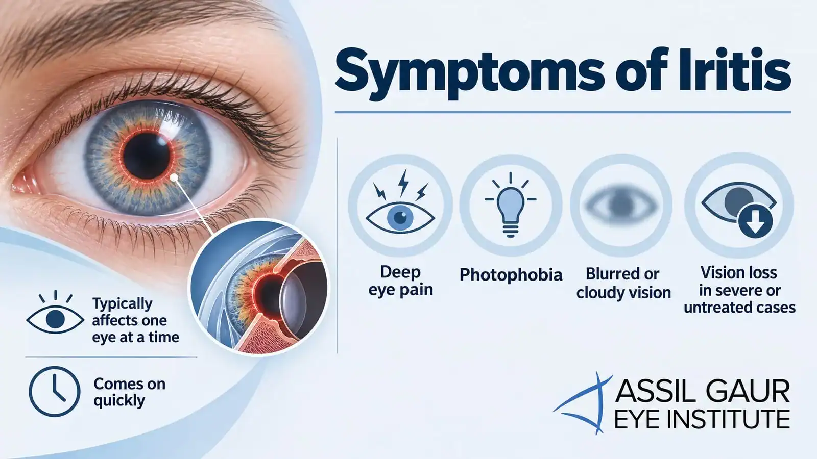 Close-up of an eye showing symptoms of iritis, including pain and blurred vision.